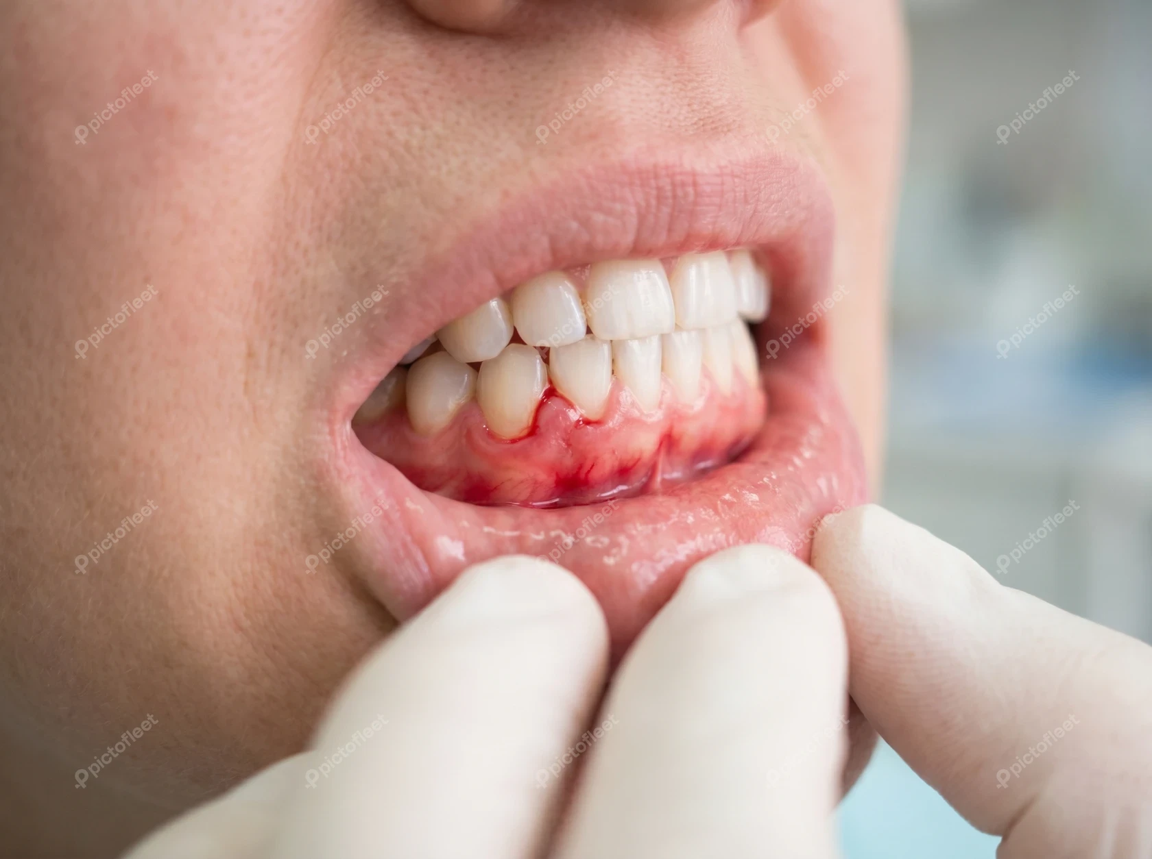 Close-up of inflamed and bleeding gums in human mouth